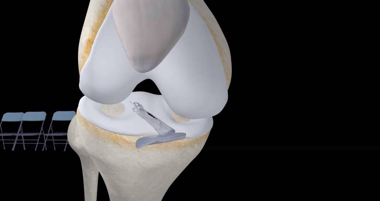 ACL Surgery Explained